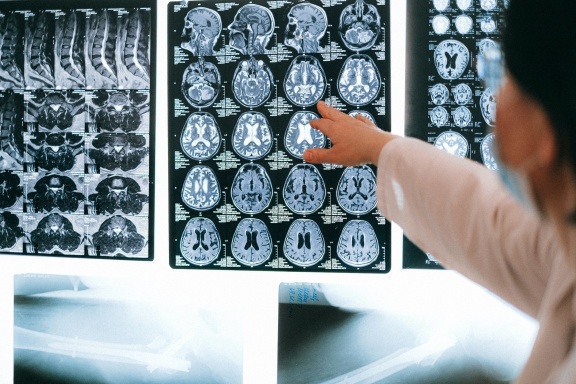 Sztuczna inteligencja pomoże w odczytywaniu wyników tomografii komputerowej mózgu